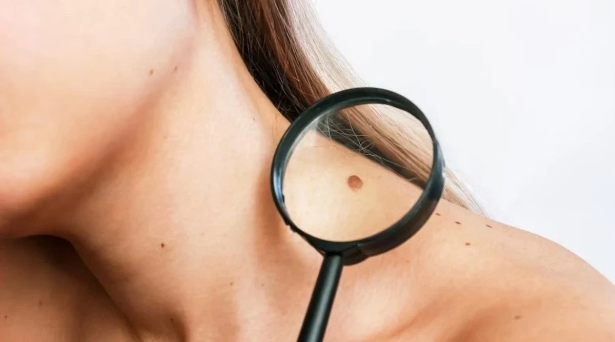 Врач рассказал, как распознать опасную родинку
 