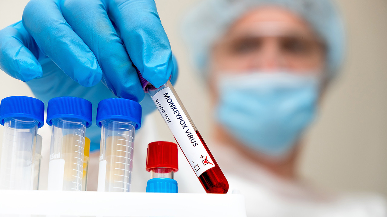 В Петербурге зафиксировали два случая оспы обезьян
 