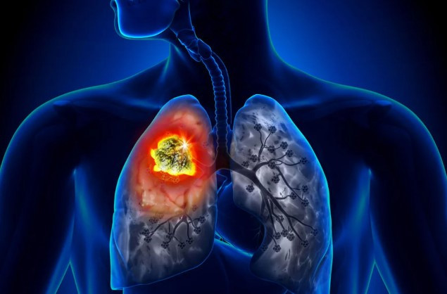 Учёные нашли способ повысить эффективность терапии агрессивного рака лёгких
 